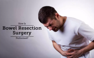 Bowel Resection Surgery