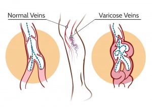 laser treatment for varicose veins in nashik | Saru hospital