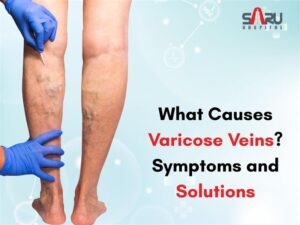 What Causes Varicose Veins? Symptoms and Solutions