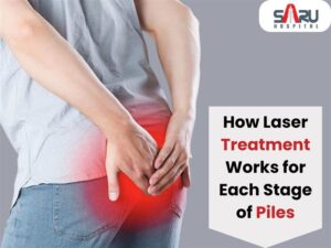 How Laser Treatment Works for Each Stage of Piles
