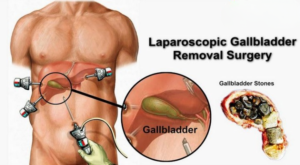 What Is Laparoscopic Cholecystectomy? Symptoms, Procedure & Recovery