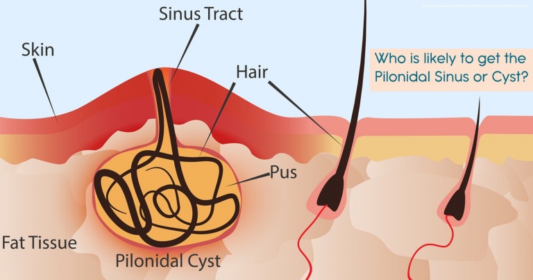 who-is-likely-to-get-the-pilonidal-sinus-or-cyst-min-768x403