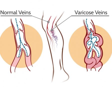 varicose-veins-vector-19087913-1-768x540
