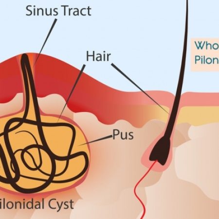 who-is-likely-to-get-the-pilonidal-sinus-or-cyst-min-768x403